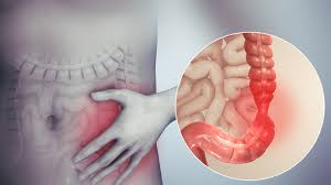 trị viêm đại tràng bằng thuốc dân gian