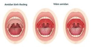 thuốc dân gian trị viêm họng