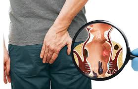 bài thuốc dân gian trị áp xe hậu môn