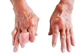 những bài thuốc dân gian trị bệnh gút