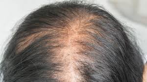 bài thuốc dân gian trị rụng tóc