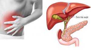thuốc dân gian trị sỏi mật
