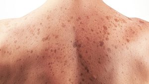 6 dấu hiệu ung thư da bạn không nên bỏ qua
