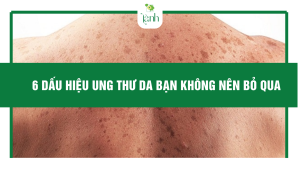 6 dấu hiệu ung thư da bạn không nên bỏ qua