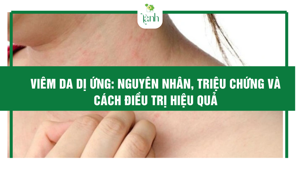 Viêm da dị ứng