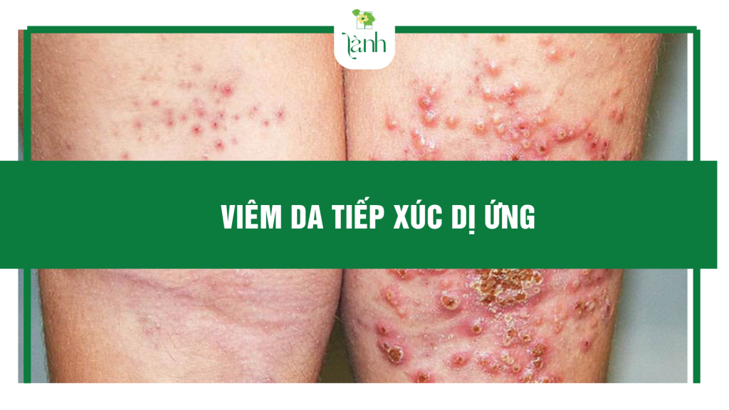 viêm da tiếp xúc dị ứng