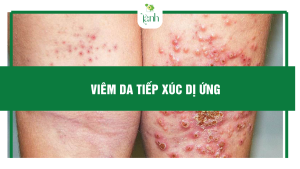 viêm da tiếp xúc dị ứng