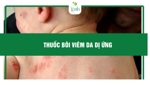 thuốc bôi viêm da dị ứng