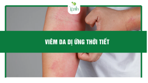 viêm da dị ứng thời tiết